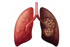 8 Mitos Penyebab Paru-paru Basah yang Sering Didengar, Benarkah?